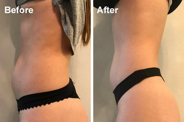 Sample Results For Fat Freezing Shared By Ice Lipo New Zealand