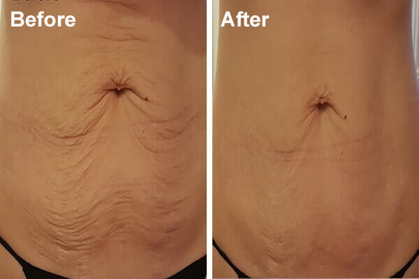 Sample Results For Skin Tightening Shared By Ice Lipo New Zealand